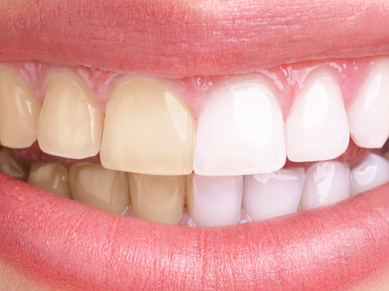 Home Remedies For Teeth Discoloration