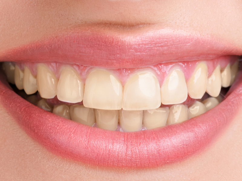 Teeth Discoloration