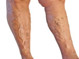15 Simple And Easy-To-Use Home Remedies For Varicose Veins