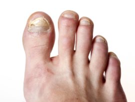 How to Get Rid of Toenail Fungus Fast and Naturally?