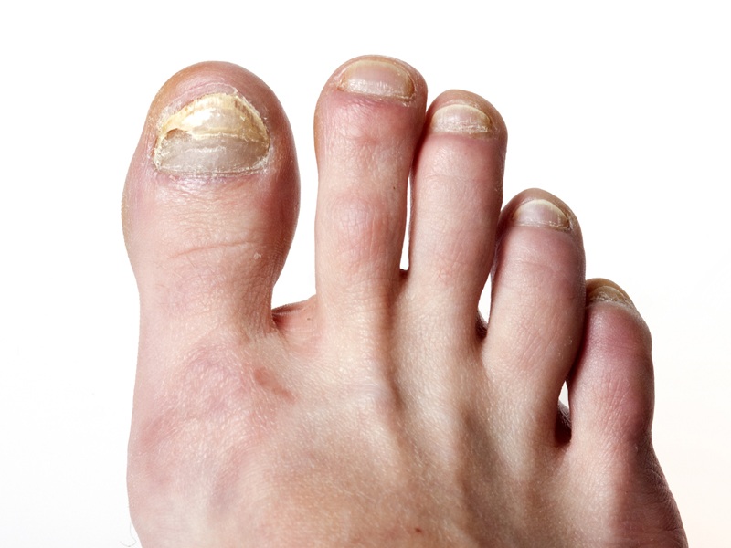 How To Get Rid Of Toenail Fungus Fast And Naturally