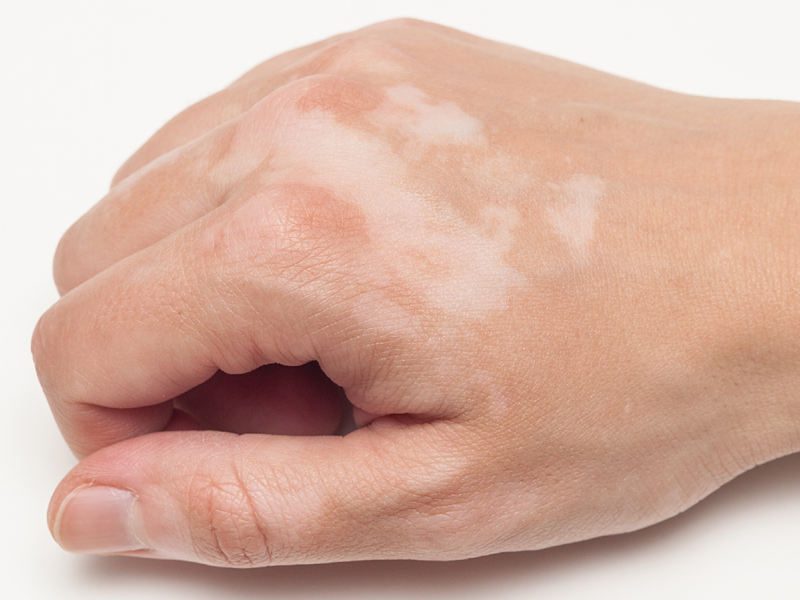White Patches Are Also Known As Vitiligo Which Is A Skin Disease That Causes Skin Discolouration