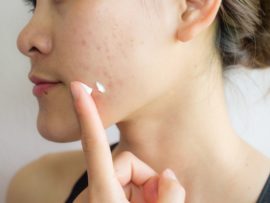 Say Goodbye to Acne with 17 Best Anti-Pimple Creams!