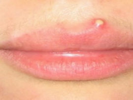 9 Best Home Remedies and Tips to Remove Pimples on Lip!