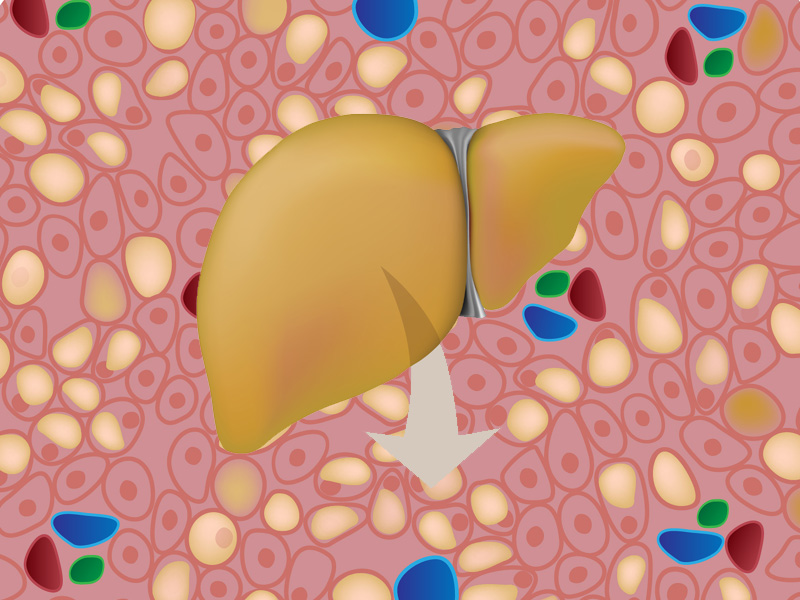 Hepatic Steatosis Signs And Causes