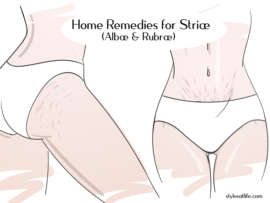 Stretch Marks: 8 Best Home Remedies for Striae (Albae & Rubrae)