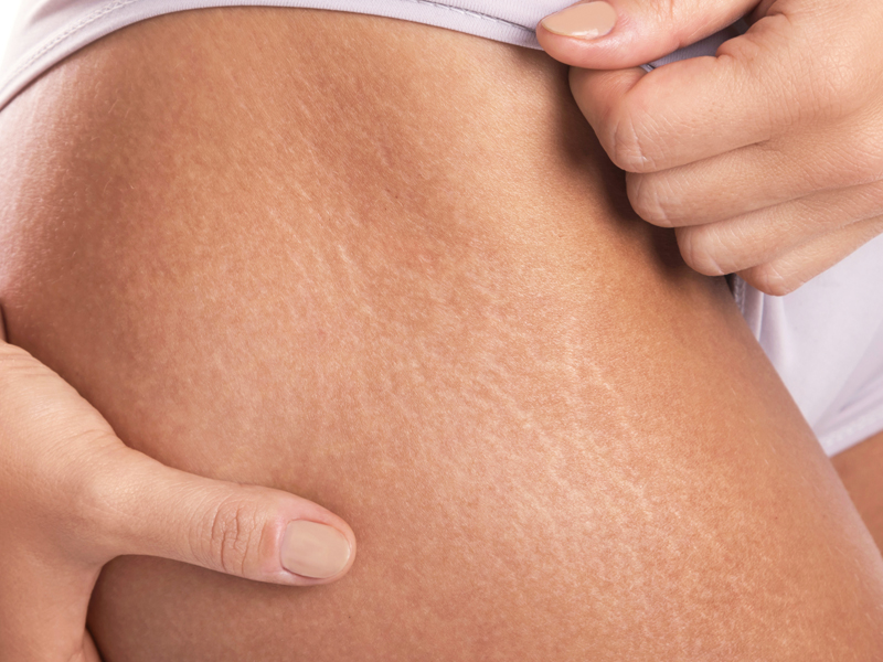 Natural Ways To Disappear For Red, White & Purple Stretch Marks