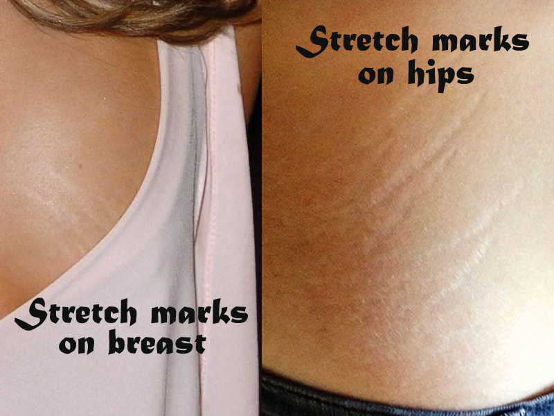 Stretchmarks On Hips And Breast