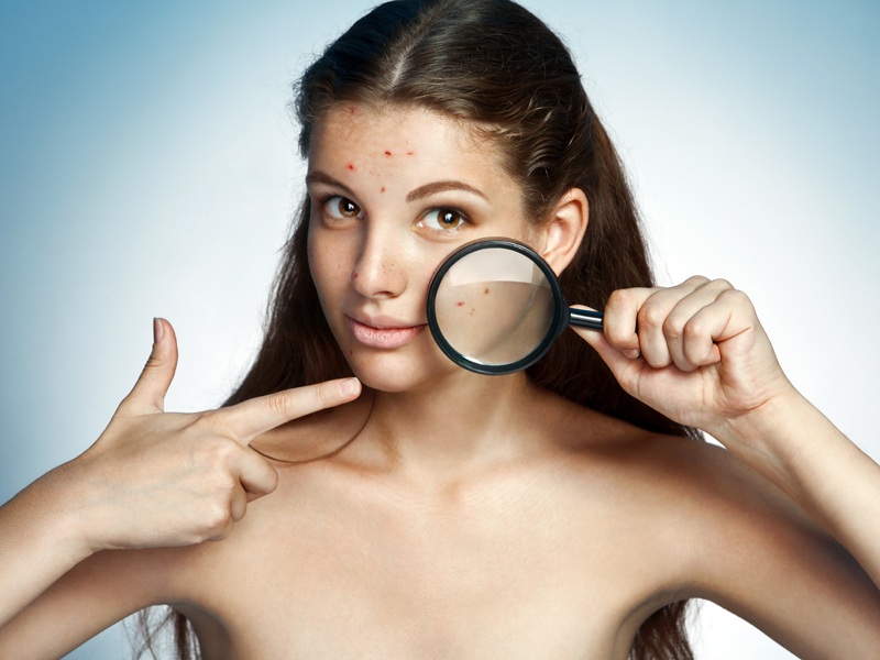 Ayurvedic Treatments For Pimples (acne) 10 Ingredients That Work!