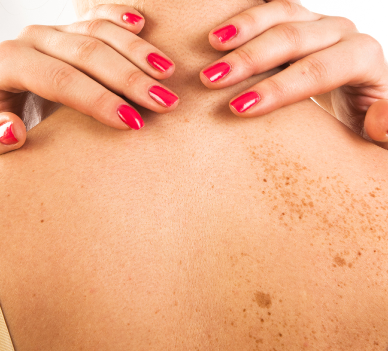 Best Treatment For Dark Spots On The Skin