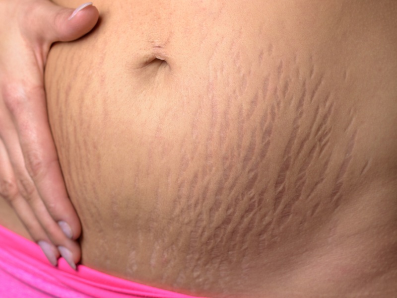 Easy Ways to Reduce Stretch Marks After Delivery