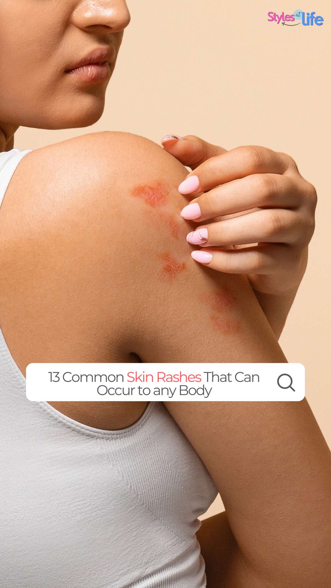 13 Common Skin Rashes That Can Occur To Any Body