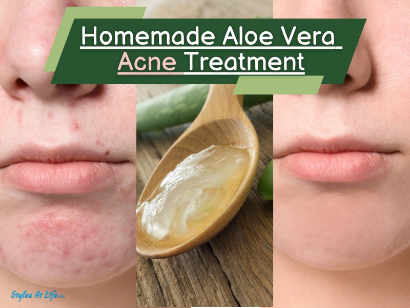 Homemade Diy Aloe Vera Acne Treatment