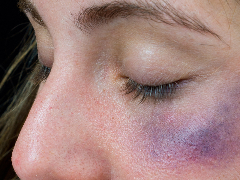 There Are Many Things You Can Do At Home To Get Rid Of The Black Eye