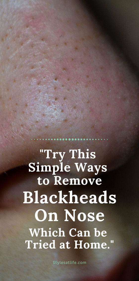 Simple Ways To Remove Blackheads On Nose