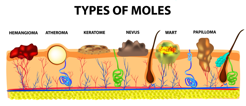 Moles Types On Different Body Parts